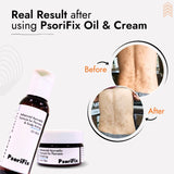 Scalp Psoriasis Skin Treatment | Best Natural Ayurvedic Solutions for Scalp Psoriasis