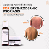 Erythrodermic Psoriasis Skin Treatment | Best Natural Ayurvedic Solutions for Erythrodermic Psoriasis