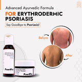 Erythrodermic Psoriasis Skin Treatment | Best Natural Ayurvedic Solutions for Erythrodermic Psoriasis