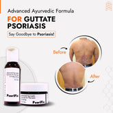 Guttate Psoriasis Skin Treatment | Best Natural Ayurvedic Solutions for Guttate Psoriasis