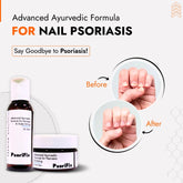 Nail Psoriasis Skin Treatment | Best Natural Ayurvedic Solutions for Nail Psoriasis