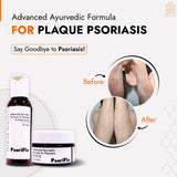 Plaque Psoriasis Skin Treatment | Best Natural Ayurvedic Solutions for Plaque Psoriasis