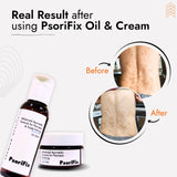 Advanced Ayurvedic Solution Kit for Psoriasis & itching (Oil + Herbal Cream)