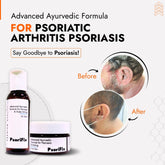 Psoriatic Arthritis Psoriasis Skin Treatment | Best Natural Ayurvedic Solutions for Psoriatic Arthritis Psoriasis