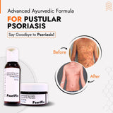 Pustular Psoriasis Skin Treatment | Best Natural Ayurvedic Solutions for Pustular Psoriasis