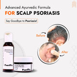 Scalp Psoriasis Skin Treatment | Best Natural Ayurvedic Solutions for Scalp Psoriasis