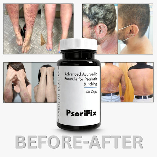 Psoriasis and the Immune System: How to Support Your Body Naturally Through Diet and Lifestyle