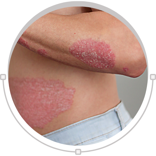 Psorifix – Ayurvedic Relief for Psoriasis & Skin Irritation