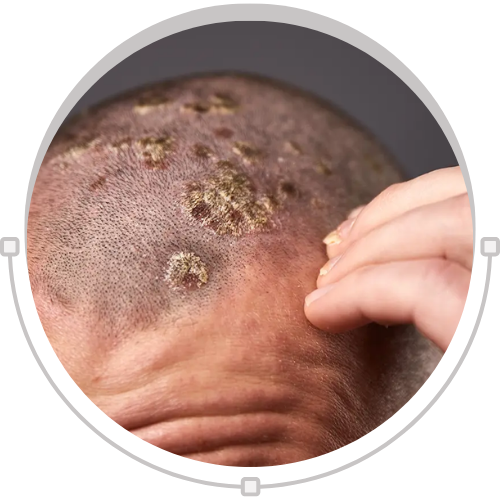 Psoriasis Relief with Psorifix – Heal Naturally with Ayurveda