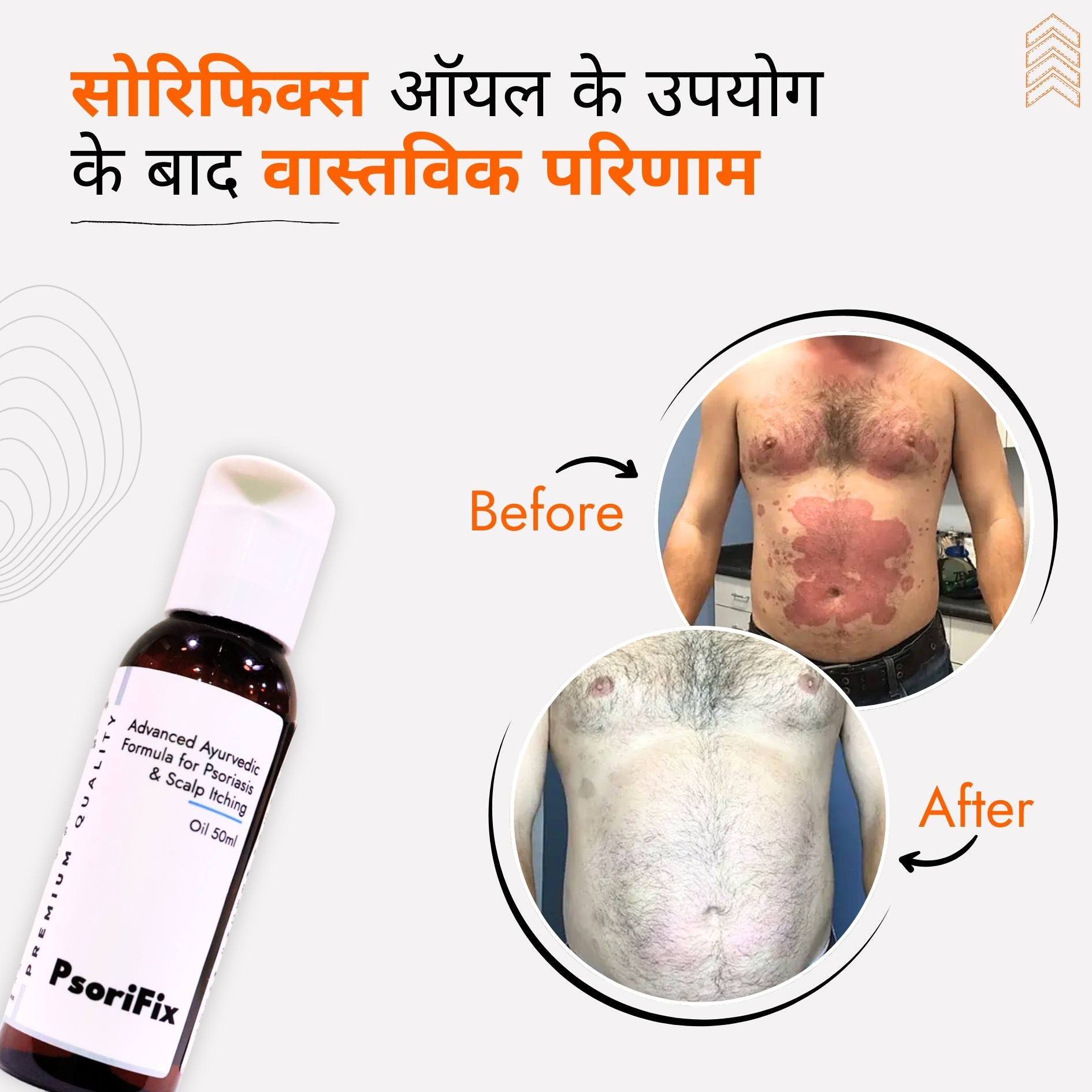 सोरायसिस व खुजली के लिए आयुर्वेदिक प्राकृतिक तेल (दिन के उपयोग के लिए)