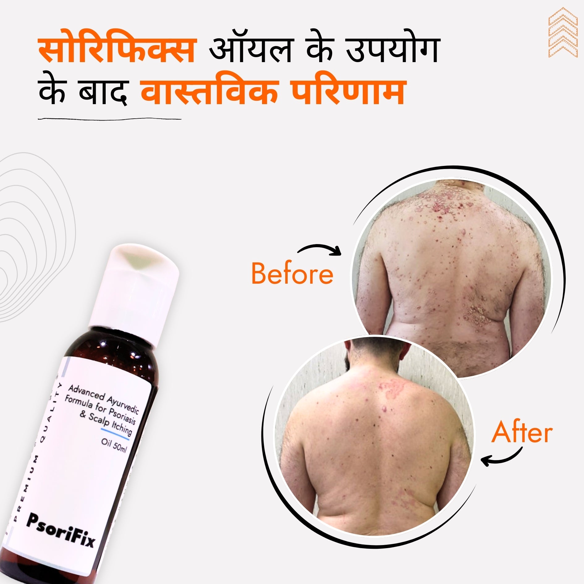 सोरायसिस व खुजली के लिए आयुर्वेदिक प्राकृतिक तेल (दिन के उपयोग के लिए)