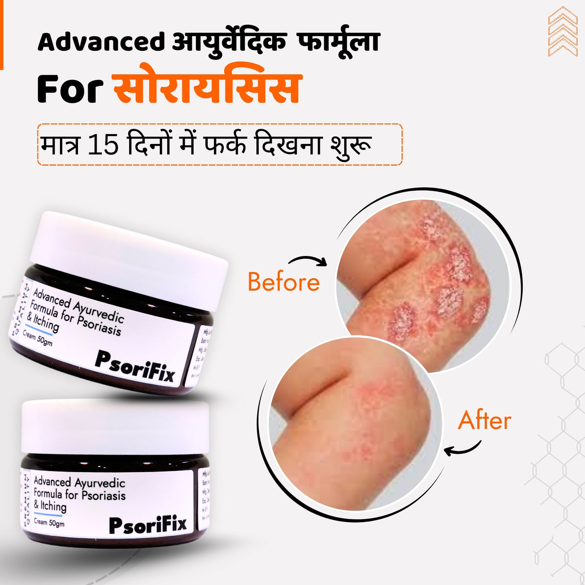 सोरायसिस व खुजली की आयुर्वेदिक क्रीम — रात में उपयोग के लिए
