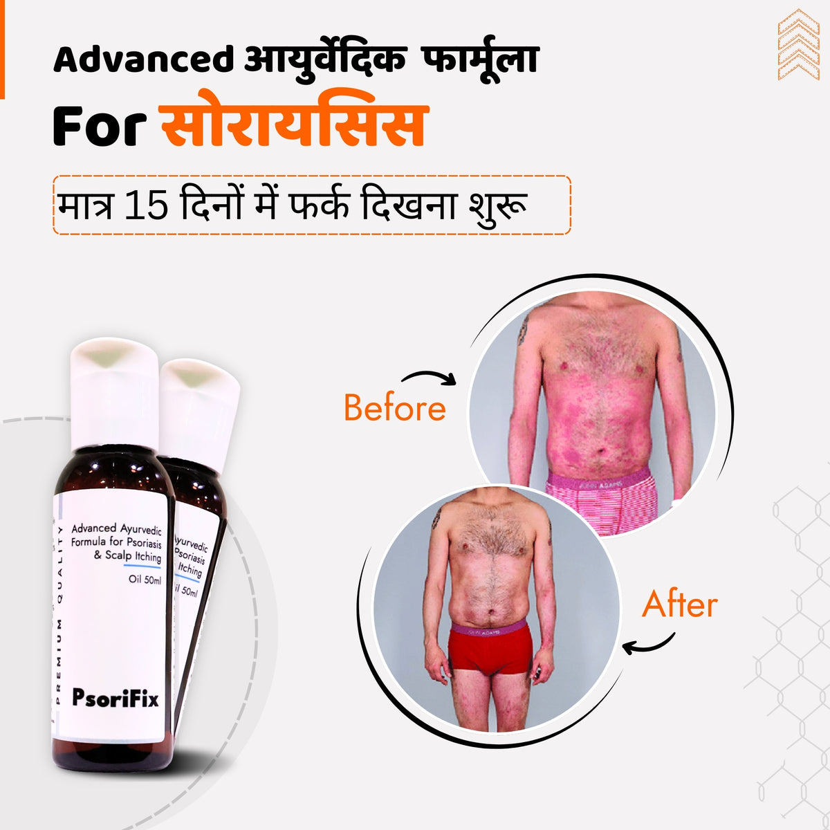 सोरायसिस व खुजली के लिए आयुर्वेदिक प्राकृतिक तेल (दिन के उपयोग के लिए)