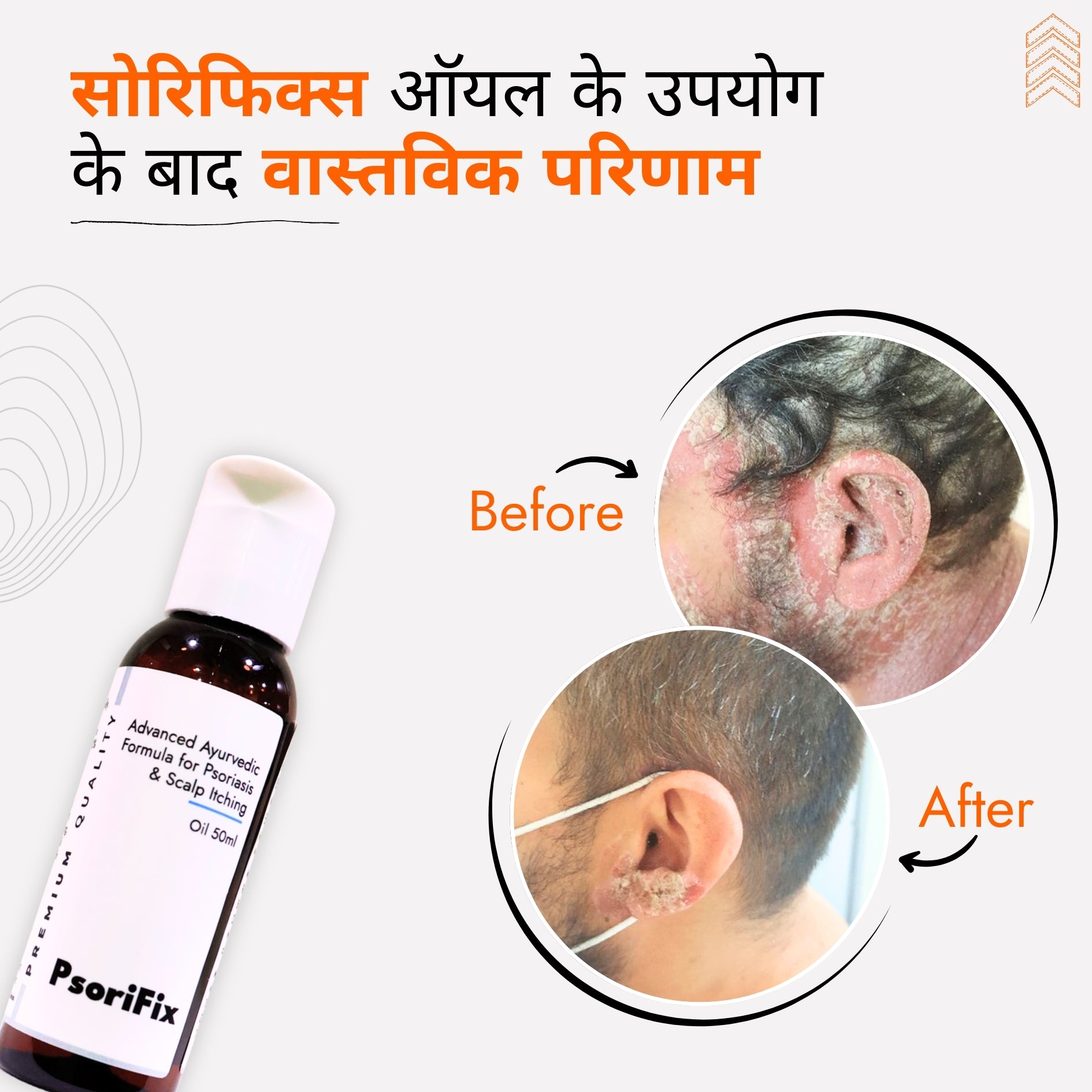 सोरायसिस व खुजली के लिए आयुर्वेदिक प्राकृतिक तेल (दिन के उपयोग के लिए)