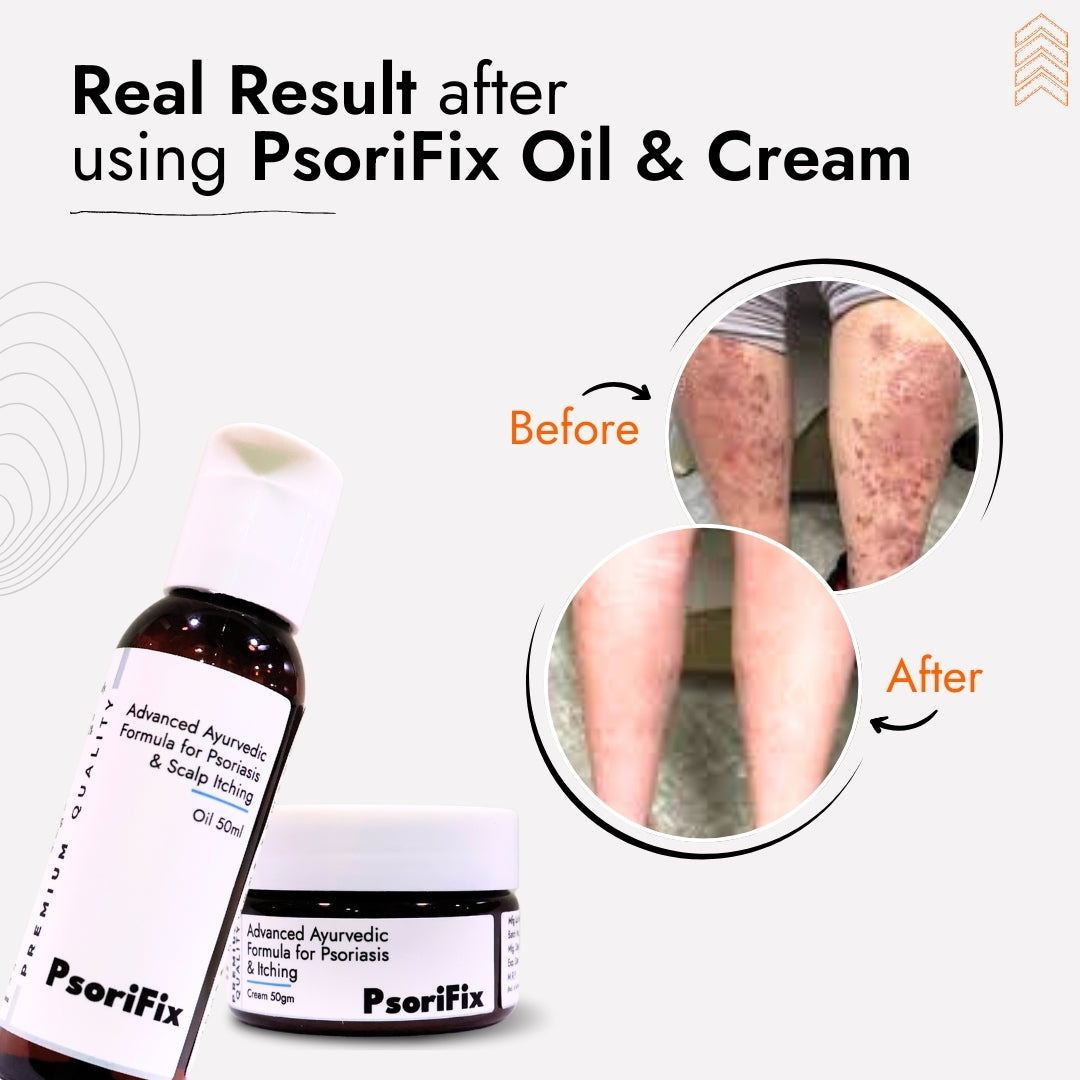 Nail Psoriasis Skin Treatment | Best Natural Ayurvedic Solutions for Nail Psoriasis