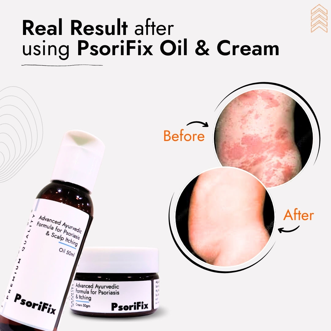 Nail Psoriasis Skin Treatment | Best Natural Ayurvedic Solutions for Nail Psoriasis