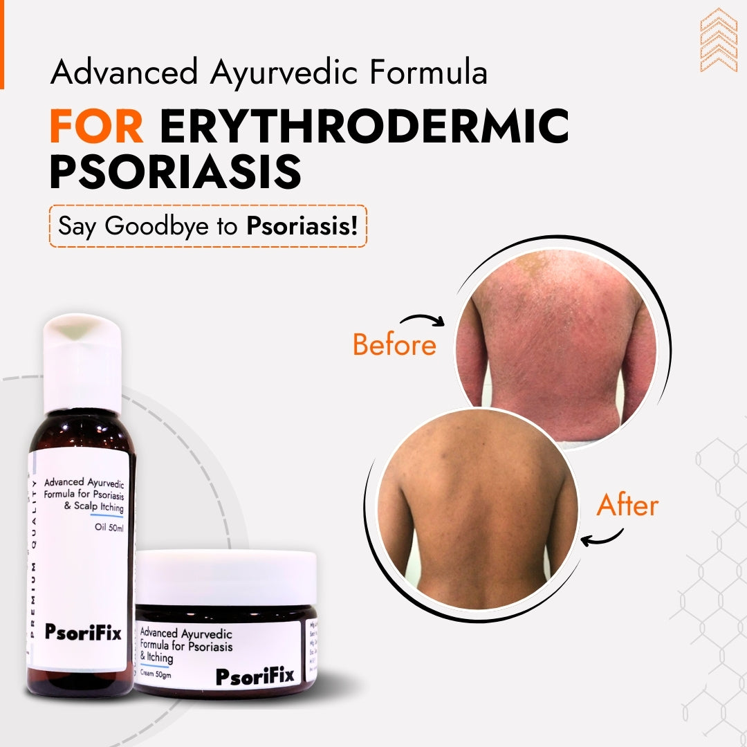 Erythrodermic Psoriasis Skin Treatment | Best Natural Ayurvedic Solutions for Erythrodermic Psoriasis