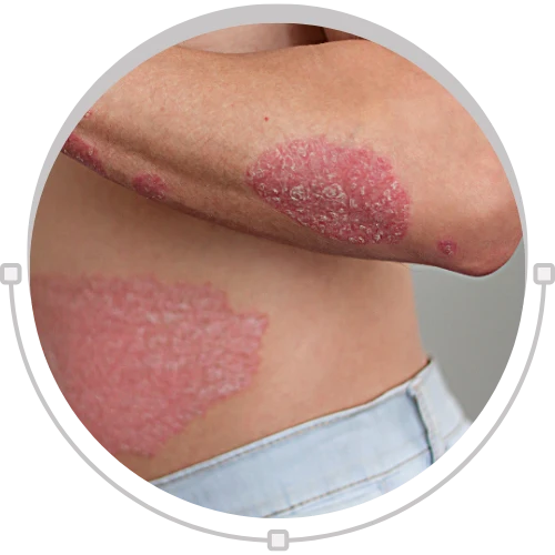 Erythrodermic Psoriasis