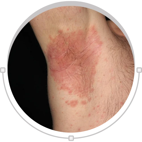 Flexural Psoriasis