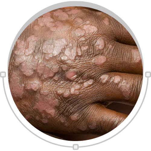Guttate Psoriasis