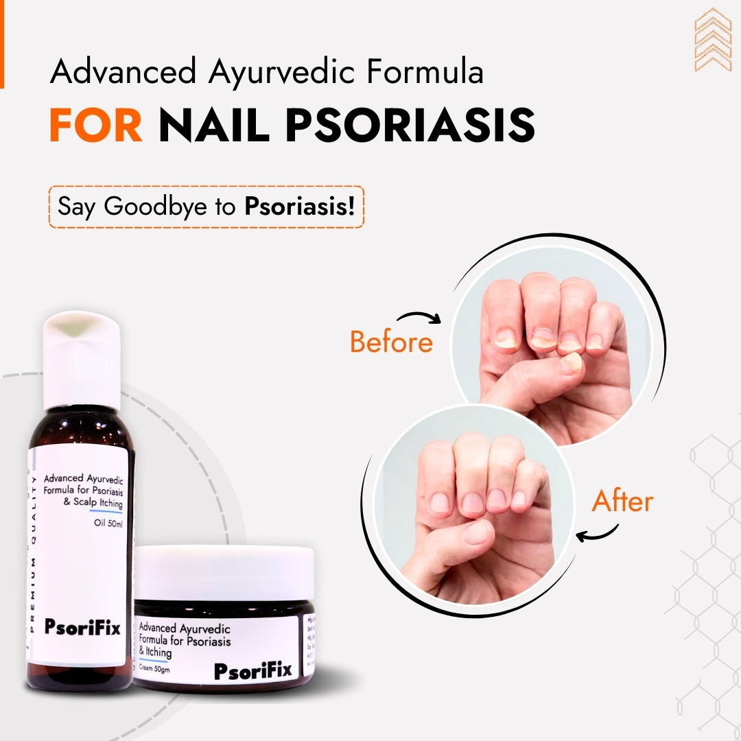Nail Psoriasis Skin Treatment | Best Natural Ayurvedic Solutions for Nail Psoriasis
