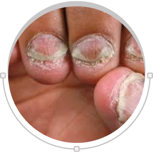 Nail Psoriasis