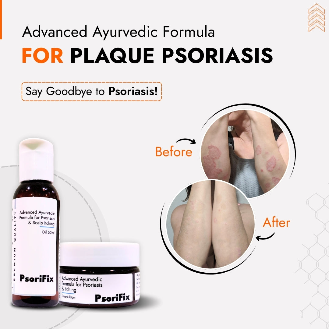 Plaque Psoriasis Skin Treatment | Best Natural Ayurvedic Solutions for Plaque Psoriasis