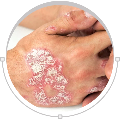 Plaque Psoriasis
