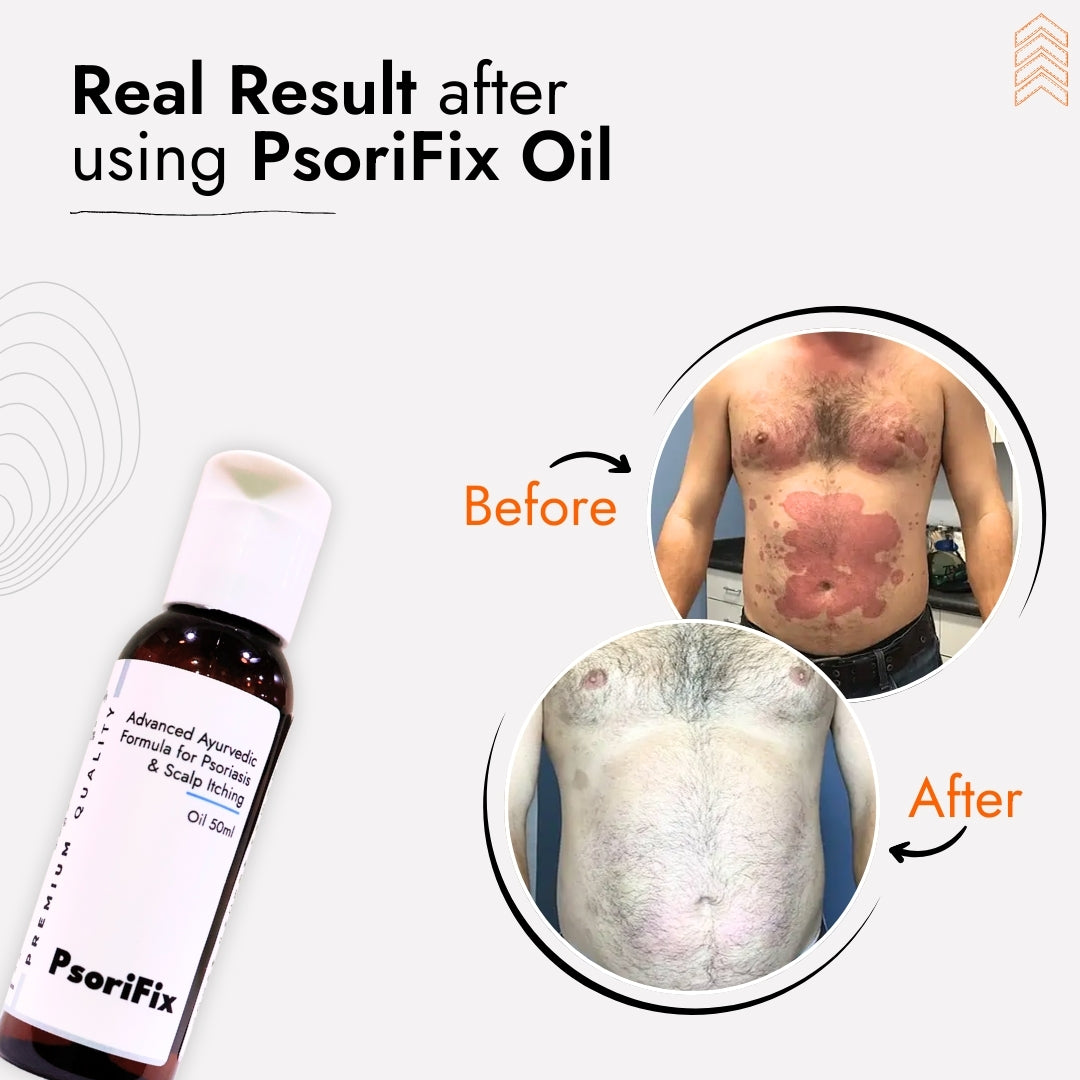 Ayurvedic Natural Oil for Psoriasis & itching (for Day Use)