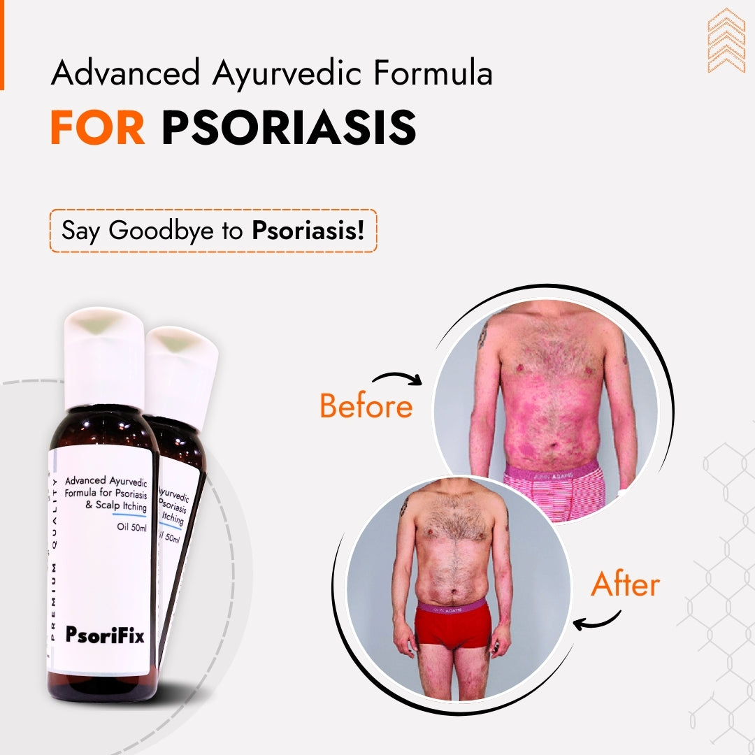 Ayurvedic Natural Oil for Psoriasis & itching (for Day Use)