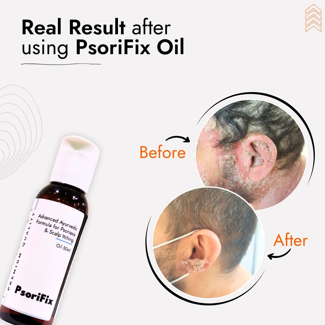 Ayurvedic Natural Oil for Psoriasis & itching (for Day Use)