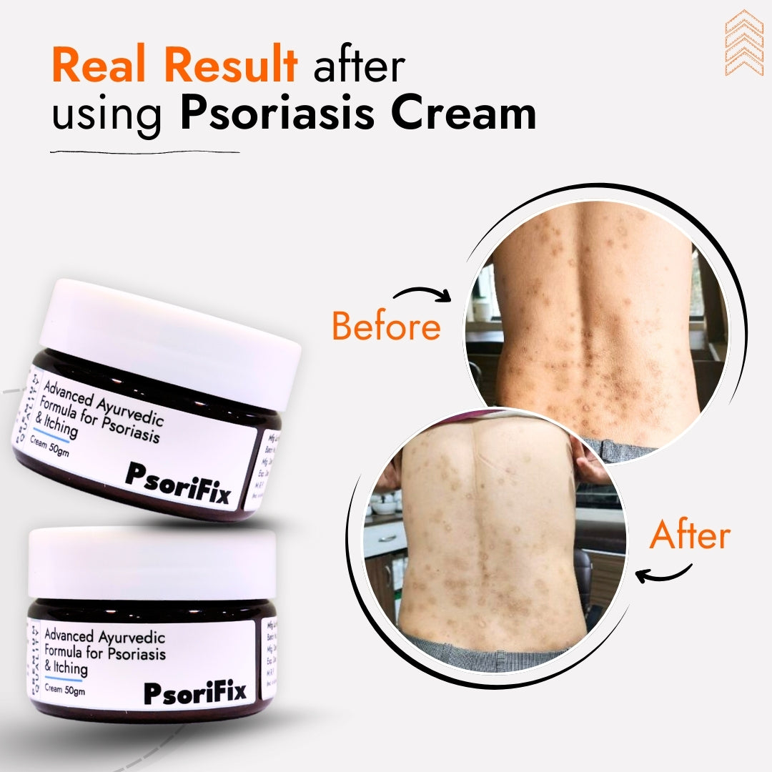 Ayurvedic Natural Cream for Psoriasis & itching (for Night Use)