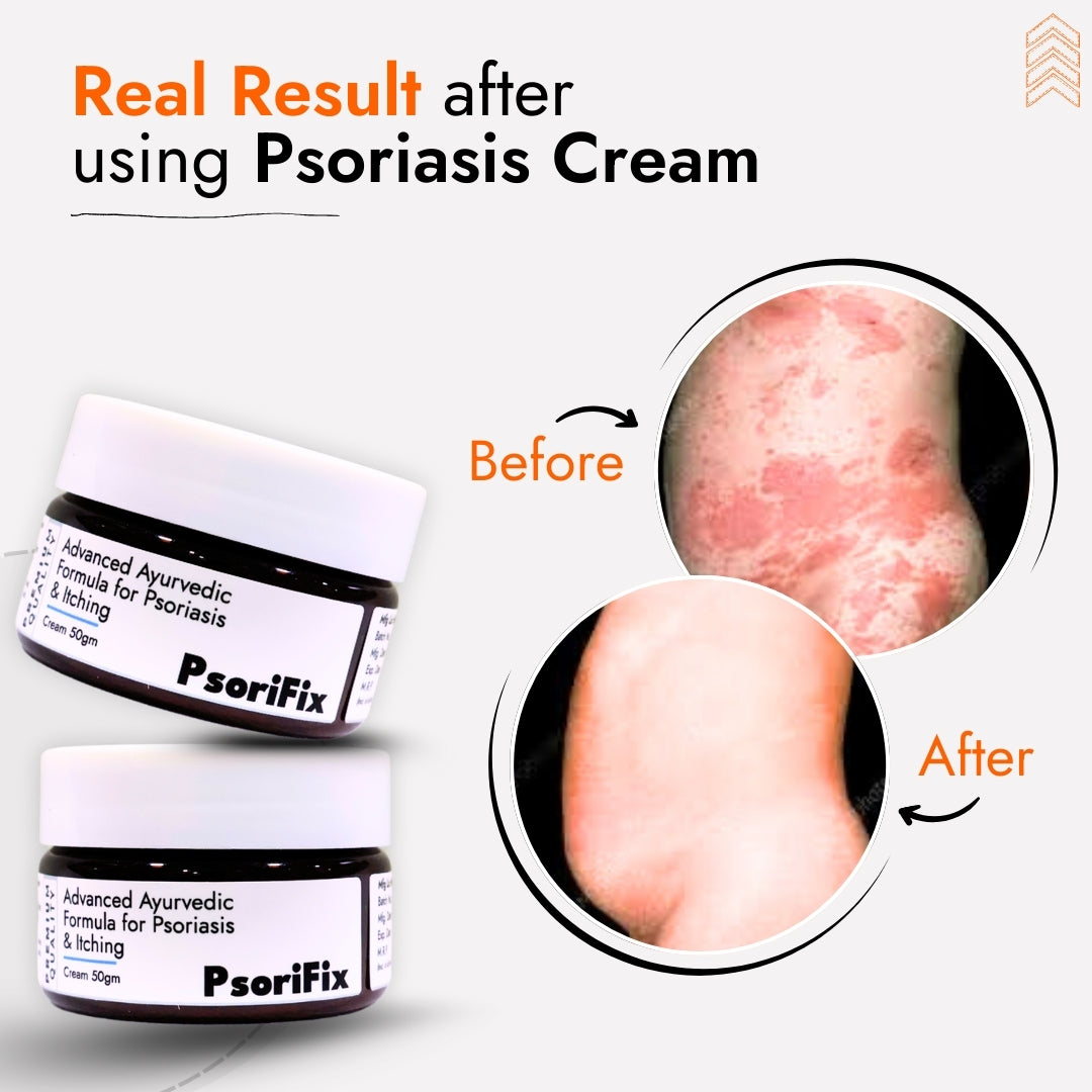 Ayurvedic Natural Cream for Psoriasis & itching (for Night Use)