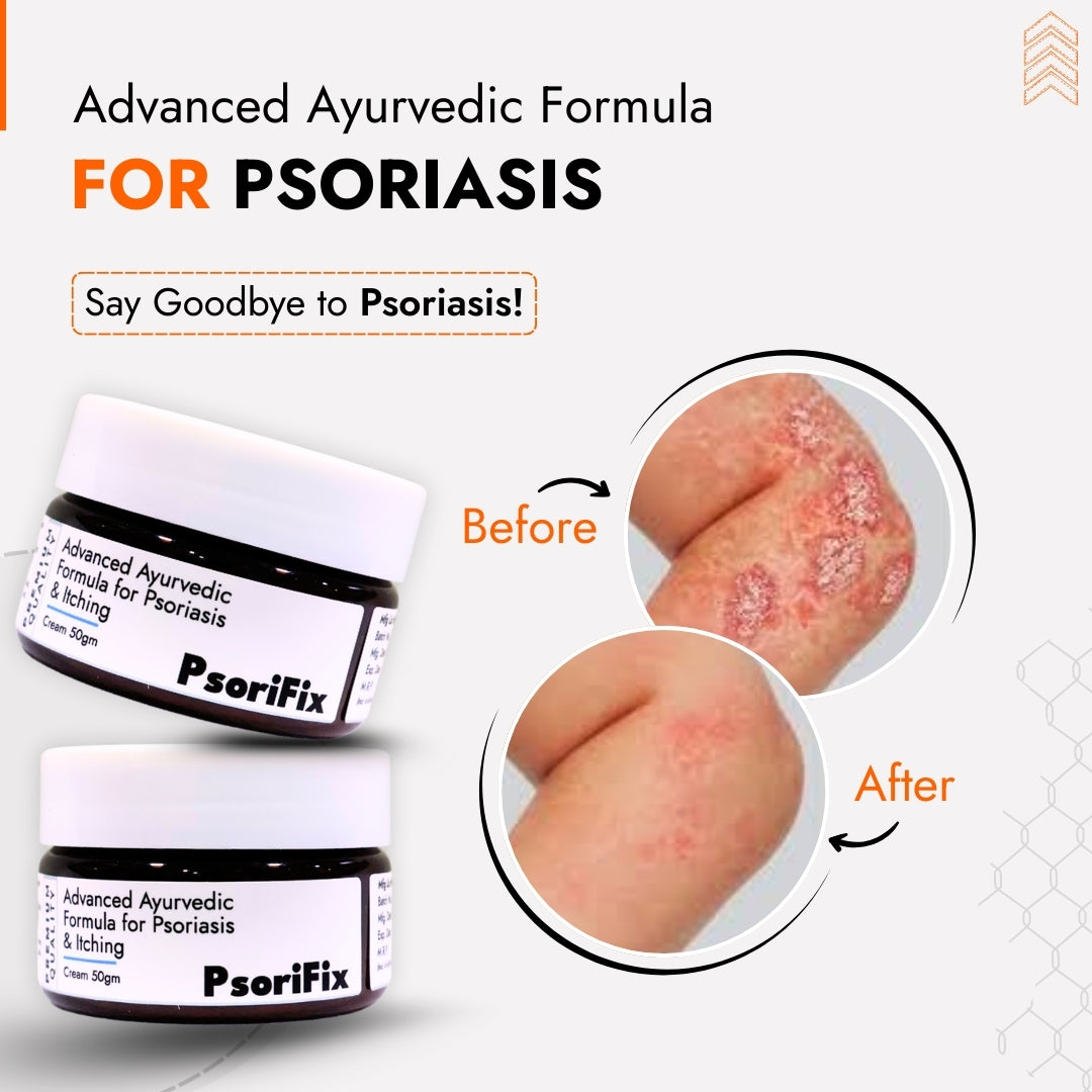 Ayurvedic Natural Cream for Psoriasis & itching (for Night Use)
