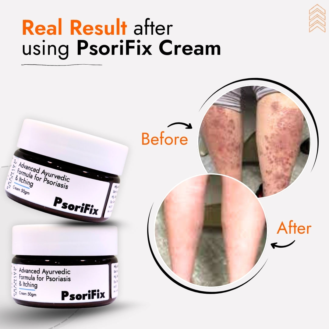 Ayurvedic Natural Cream for Psoriasis & itching (for Night Use)