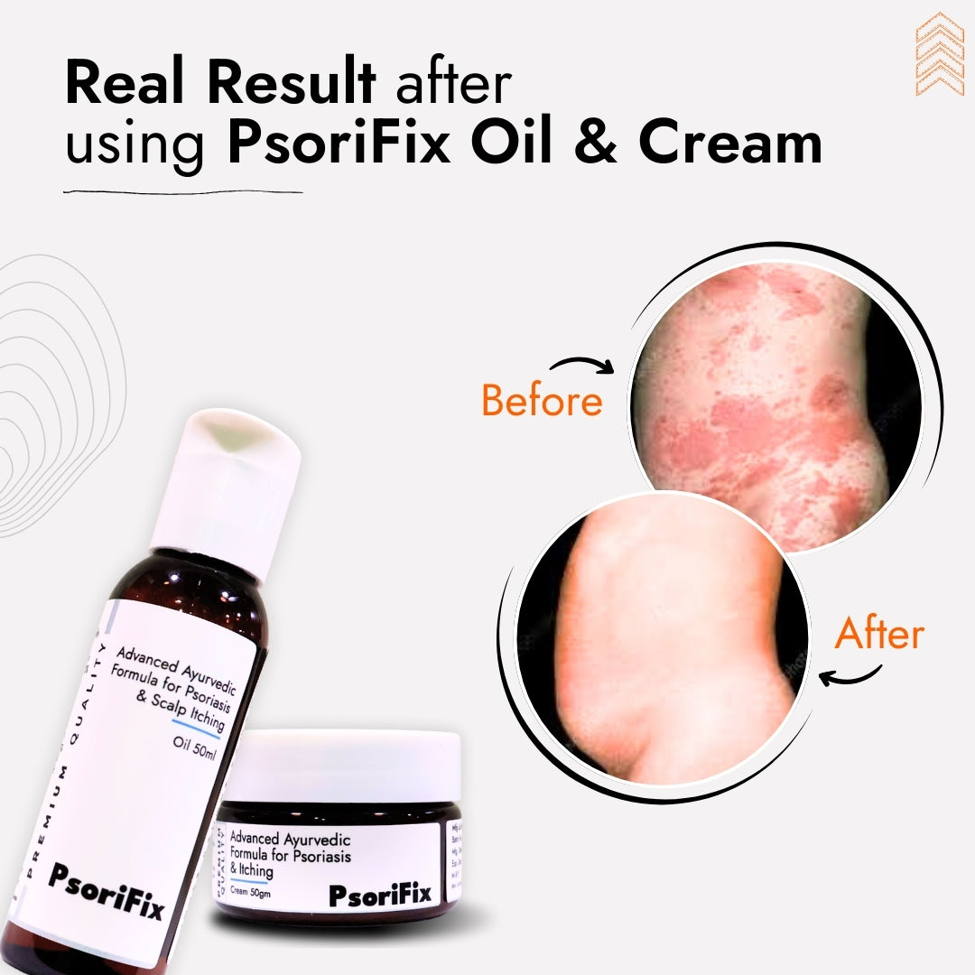 Advanced Ayurvedic Solution Kit for Psoriasis & itching (Oil + Herbal Cream)