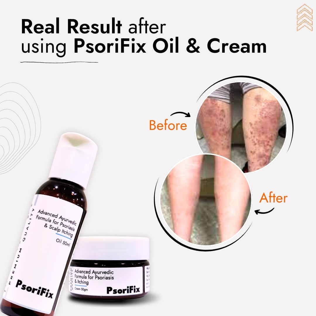 Advanced Ayurvedic Solution Kit for Psoriasis & itching (Oil + Herbal Cream)