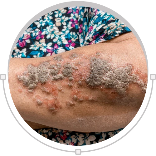 Psoriatic Arthritis Psoriasis