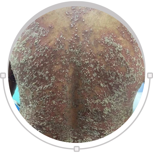 Pustular Psoriasis