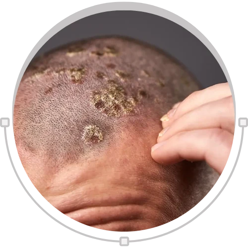 Scalp Psoriasis